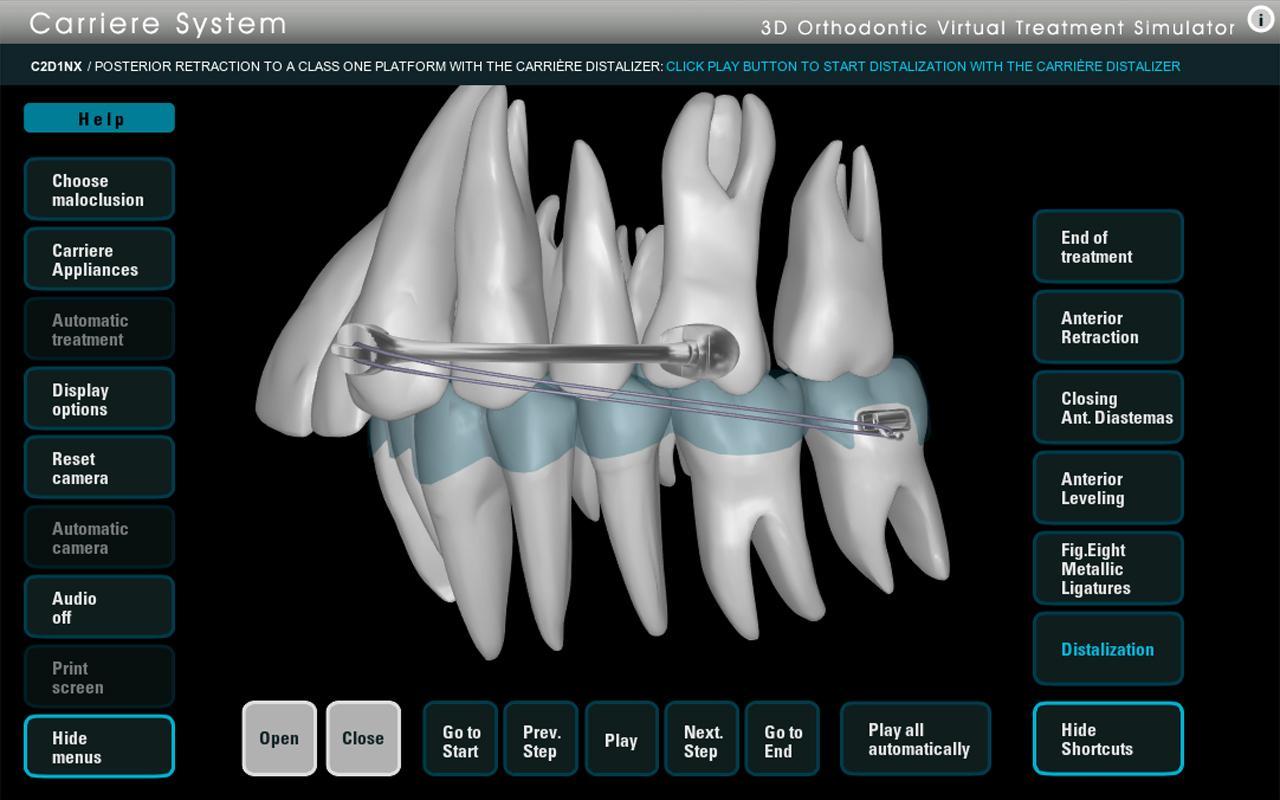 Carriere Ortho 3D截图2