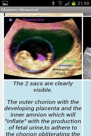 Obstetric Ultrasound-Lite截图1