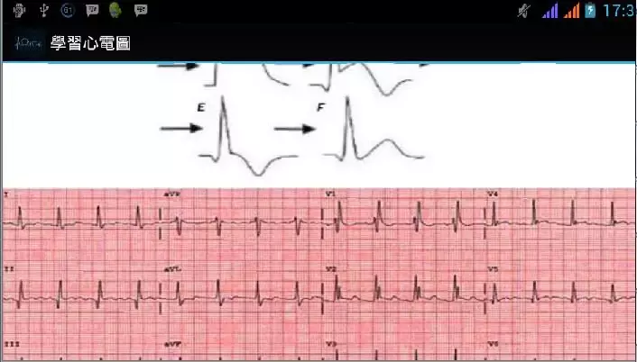 學習心電圖截图4