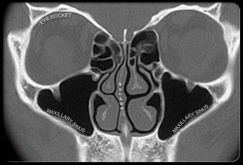 Sinus Infection Symptoms截图5