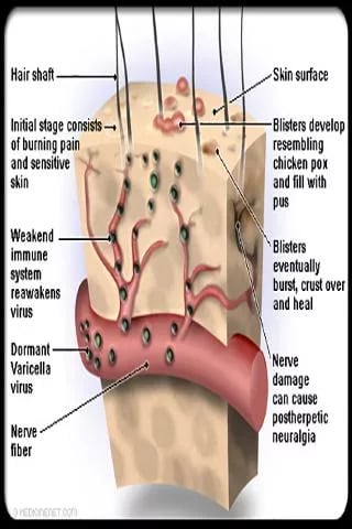 Shingles Symptoms Treatm...截图3