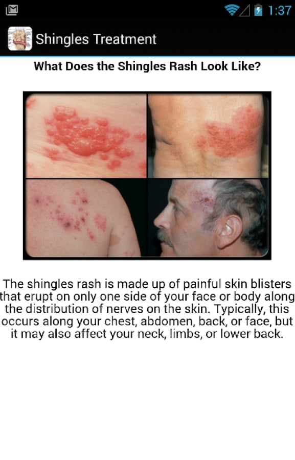 Shingles Symptoms Treatm...截图8