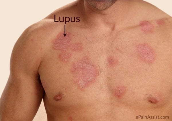 Lupus Symptoms Treatment截图3