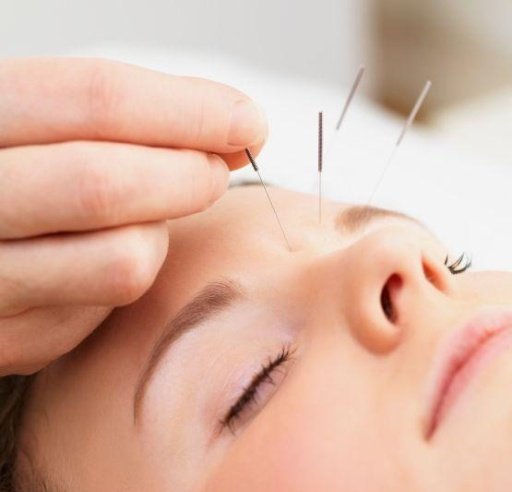 acupuncture截图1