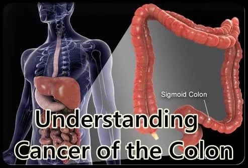 Understanding Cancer of ...截图1