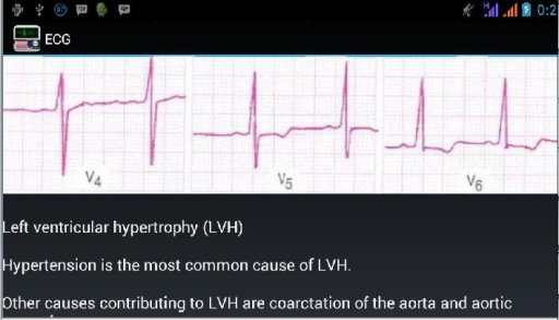 Ecg Interpretation截图1