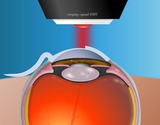 Virtual LASIK Eye Surgery截图1