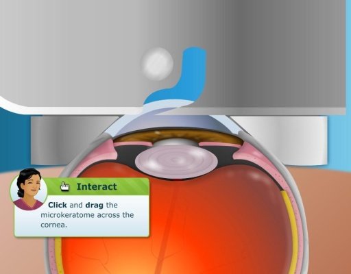 Virtual LASIK Eye Surgery截图4