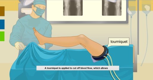 Virtual Knee Surgery截图4