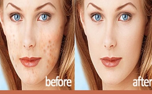 Instant Acne Remover截图1