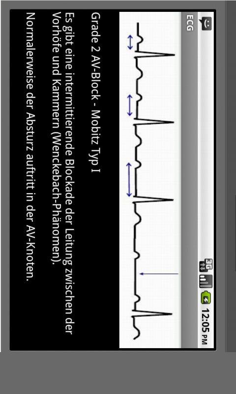 Elektrokardiogramm EKG Typen截图7