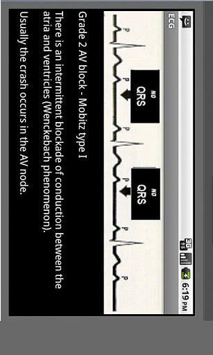 Electrocardiogram ECG Types截图5