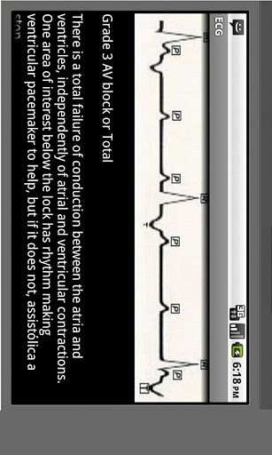 Electrocardiogram ECG Types截图2