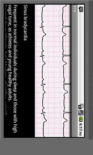 Electrocardiogram ECG Types截图3