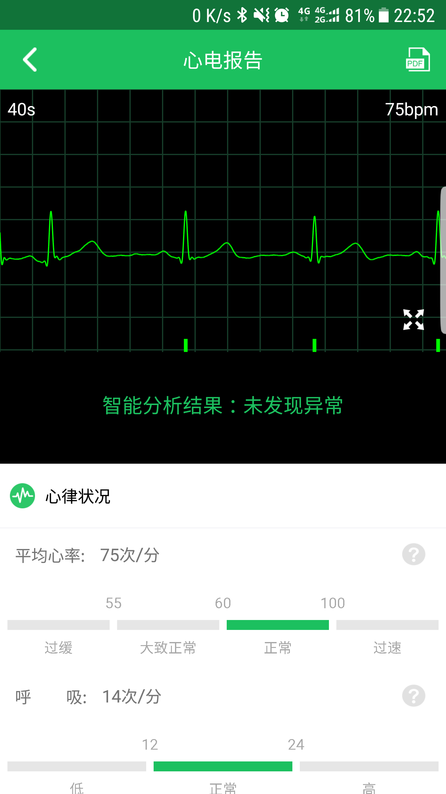 极简心电截图5